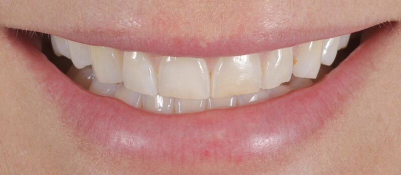 Before - Veneers at Concord Dental & Orthodontics