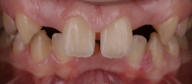 Before - Veneers at Concord Dental & Orthodontics