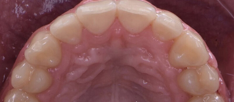 After - Braces at Concord Dental & Orthodontics