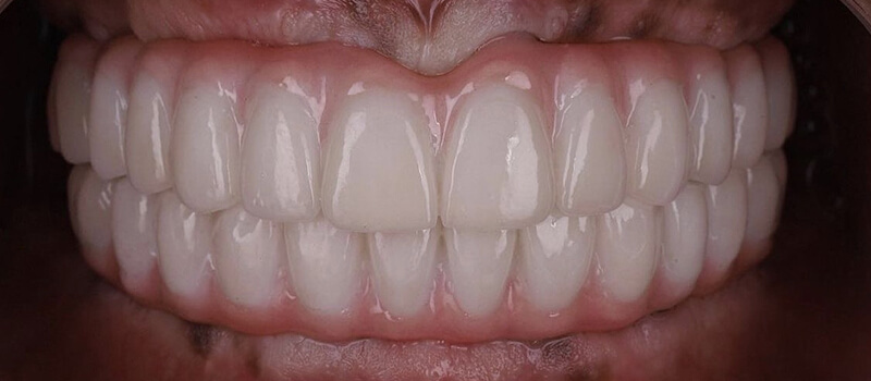 After - All-on-4 at Concord Dental & Orthodontics