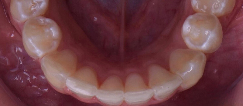 After - Invisalign at Concord Dental & Orthodontics