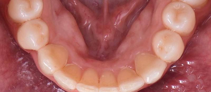 After - Invisalign at Concord Dental & Orthodontics