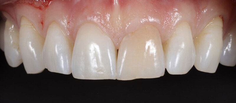 Before - Veneers at Concord Dental & Orthodontics