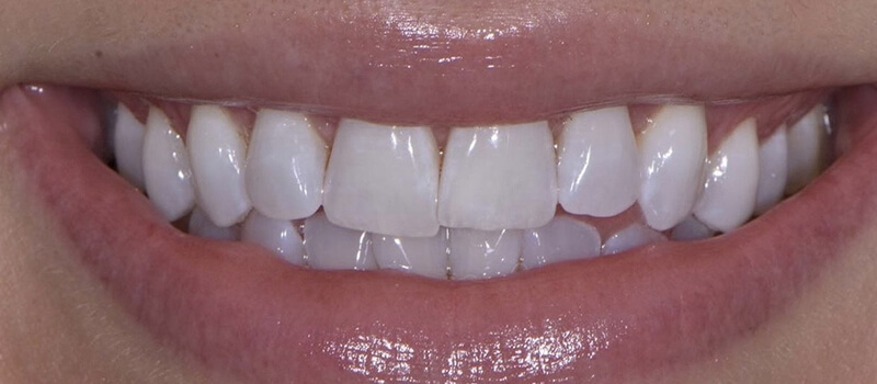 Before - Invisalign at Concord Dental & Orthodontics