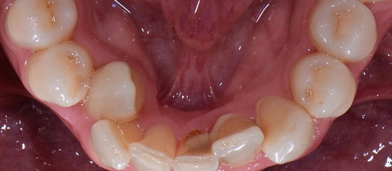 Before - Invisalign at Concord Dental & Orthodontics